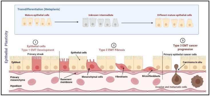 Metabolomics and EMT Markers of Breast Cancer: A Crosstalk and Future Perspective.