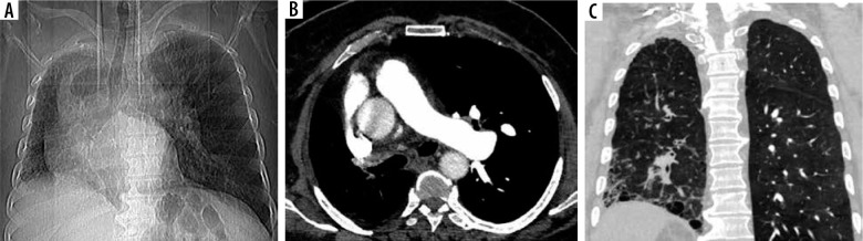 Diagnostic performance and inter-observer variability of CO-RADS in the triage of patients with suspected COVID-19 infection: initial experience in Zagazig University Hospital.