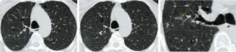 Diagnostic performance and inter-observer variability of CO-RADS in the triage of patients with suspected COVID-19 infection: initial experience in Zagazig University Hospital.