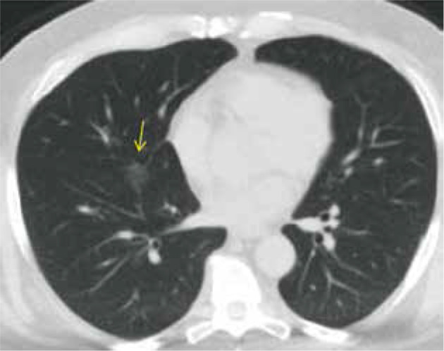 Diagnostic performance and inter-observer variability of CO-RADS in the triage of patients with suspected COVID-19 infection: initial experience in Zagazig University Hospital.