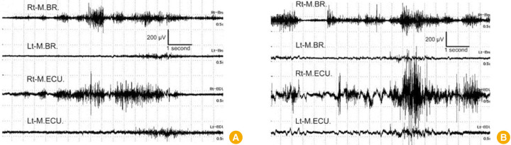 Thalamic hemi-chorea: a rare complication after receiving the adenoviral vector-based COVID-19 vaccine: a case report.