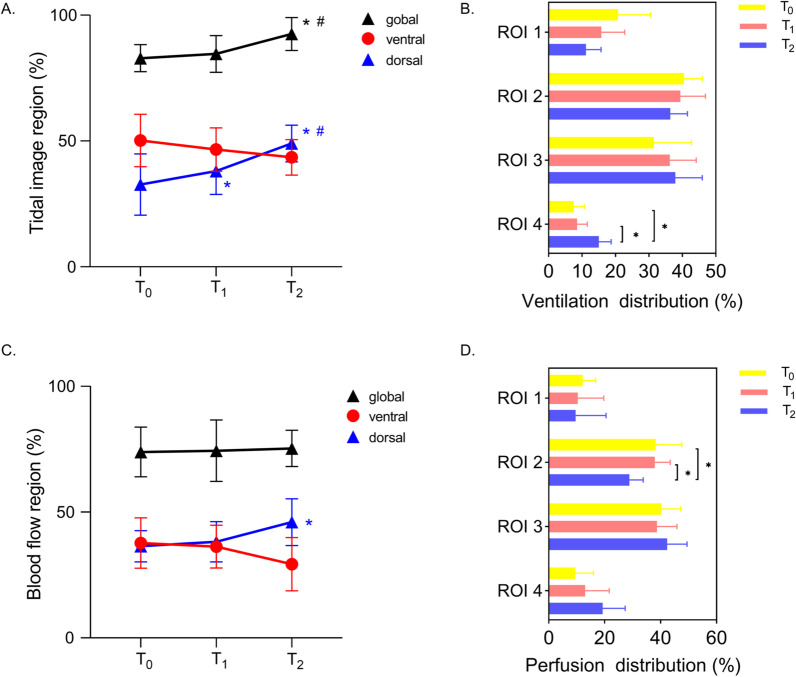 Prone positioning improves ventilation-perfusion matching assessed by electrical impedance tomography in patients with ARDS: a prospective physiological study.