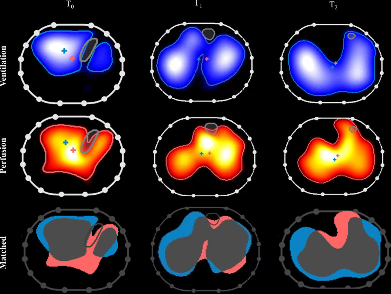 Prone positioning improves ventilation-perfusion matching assessed by electrical impedance tomography in patients with ARDS: a prospective physiological study.