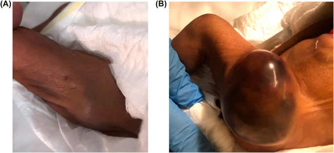 Severe hematoma following the use of low molecular weight heparin in preterm neonate.