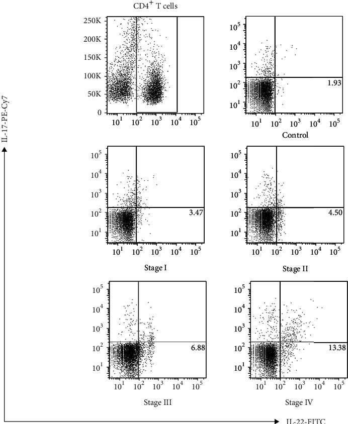 Th22 Cells/IL-22 Serves as a Protumor Regulator to Drive Poor Prognosis through the JAK-STAT3/MAPK/AKT Signaling Pathway in Non-Small-Cell Lung Cancer.