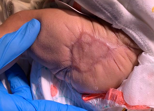 Severe hematoma following the use of low molecular weight heparin in preterm neonate.