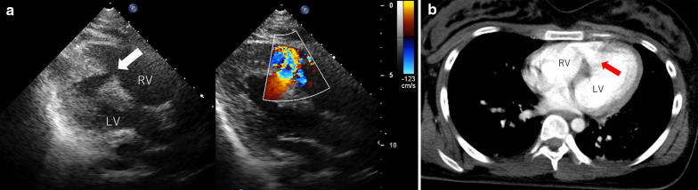 Ventricular septal rupture after blunt chest trauma: a case report.