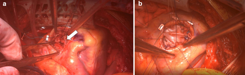 Ventricular septal rupture after blunt chest trauma: a case report.