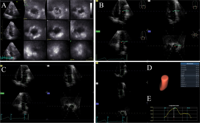 Left atrial morpho-functional remodeling in atrial fibrillation assessed by three dimensional speckle tracking echocardiography and its value in atrial fibrillation screening.