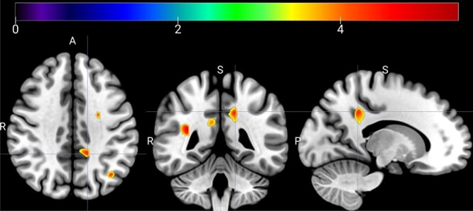 Neuroanatomical correlates of working memory performance in Neurofibromatosis 1.