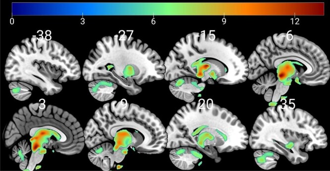 Neuroanatomical correlates of working memory performance in Neurofibromatosis 1.
