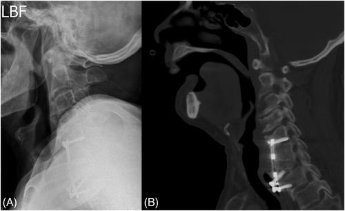 A rare etiology of esophageal perforation