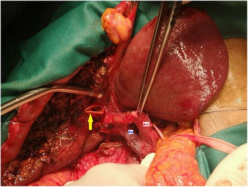 Adenosquamous carcinoma of gallbladder associated with biliopancreatic maljunction and Todani 1c choledochal cyst: A case report