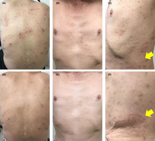 Development of tinea corporis in a Japanese patient with atopic dermatitis under treatment with upadacitinib in a real-world clinical setting: Possible contribution of the suppression of Th17