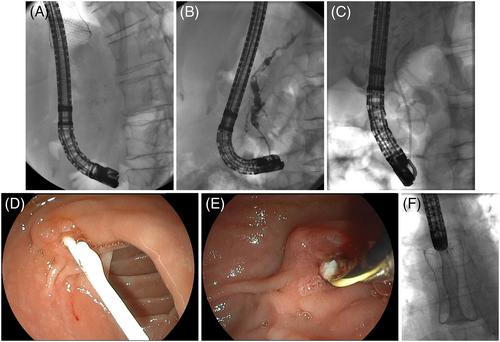 Through-the-esophageal-stent diagnostics and intervention of pancreaticolithiasis complicated by high-grade esophageal stricture