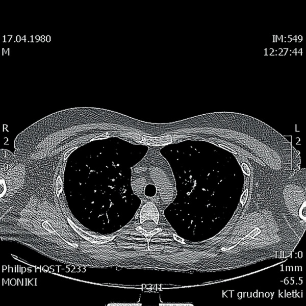 [Panhypopituitarism as the first manifestation of sarcoidosis: case report].