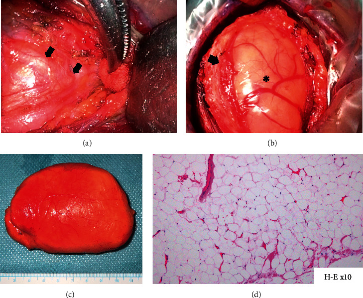 A Case of Cervical Intraneural Lipoma That Was Removed by Intercapsular Resection with No Resultant Postoperative Neurological Deficit.