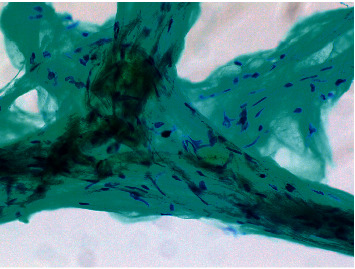 A Case of Cervical Intraneural Lipoma That Was Removed by Intercapsular Resection with No Resultant Postoperative Neurological Deficit.