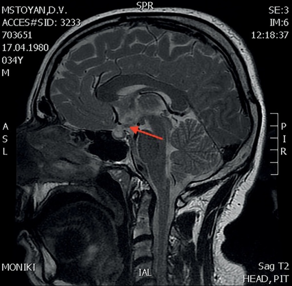 [Panhypopituitarism as the first manifestation of sarcoidosis: case report].