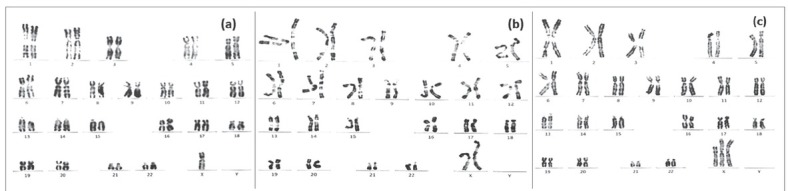 Double Isochromosome X, a Rare Cytogenetic Variant of Turner Syndrome: A Case Report and a Review of the Literature.