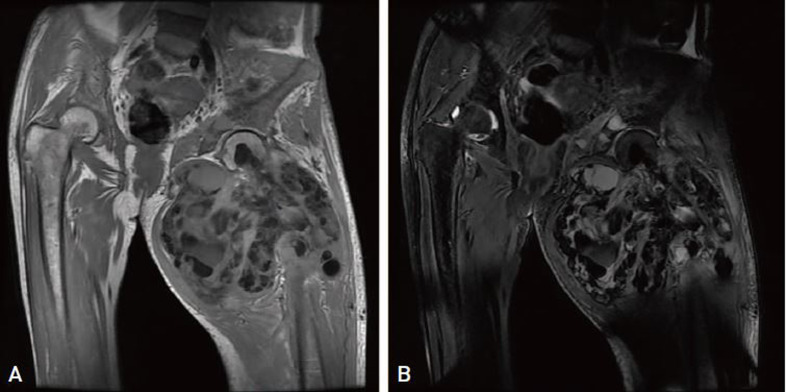 Pathologic Fracture of Femoral Neck in a Patient with Tumoral Calcinosis.