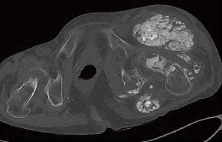 Pathologic Fracture of Femoral Neck in a Patient with Tumoral Calcinosis.