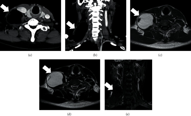 A Case of Cervical Intraneural Lipoma That Was Removed by Intercapsular Resection with No Resultant Postoperative Neurological Deficit.