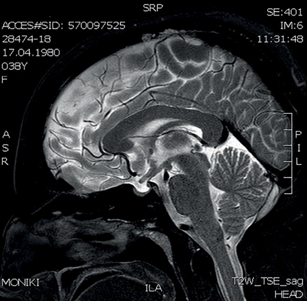 [Panhypopituitarism as the first manifestation of sarcoidosis: case report].