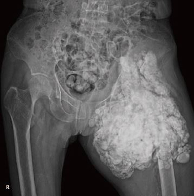 Pathologic Fracture of Femoral Neck in a Patient with Tumoral Calcinosis.