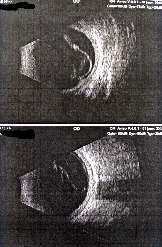 [Ocular syphilis associated to HIV: A report of 2 patients treated in Marrakech, Morocco].