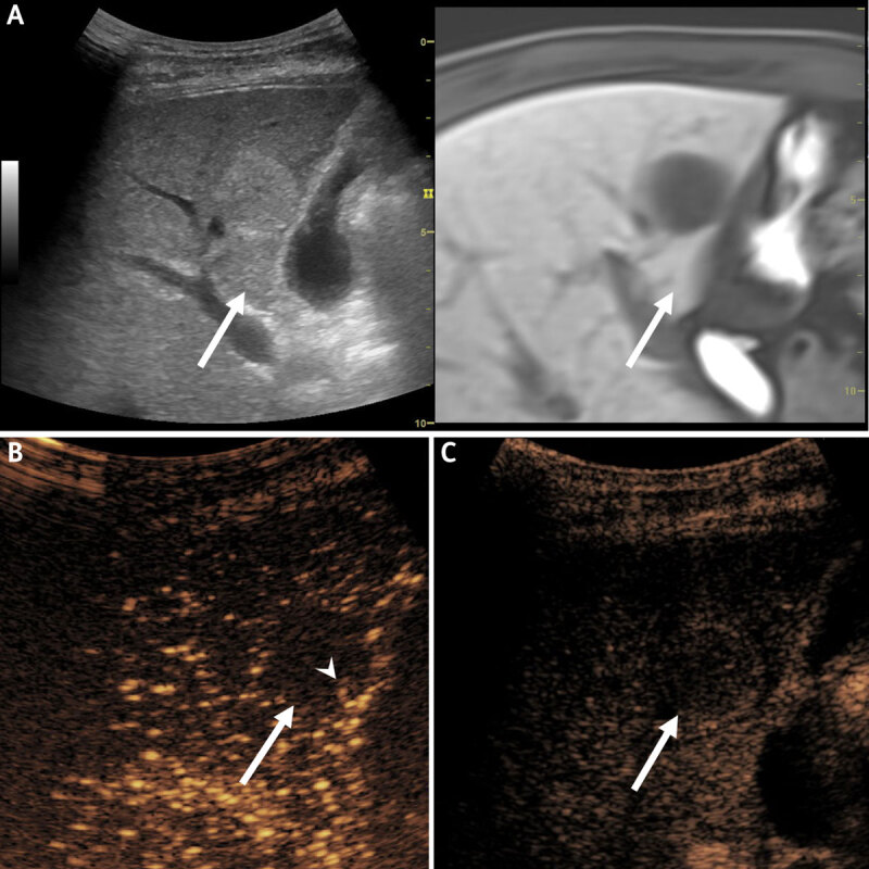 Atypical Hepatic Hemangioma with Fluid-Fluid Level on CT and MRI: Emphasis on Added Value of Contrast-Enhanced Ultrasound Findings.