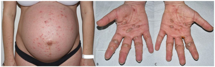 Pseudo-Pemphigoid Gestationis Eruption Following SARS-CoV-2 Vaccination with mRNA Vaccine.