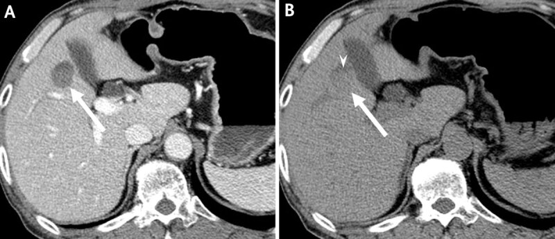 Atypical Hepatic Hemangioma with Fluid-Fluid Level on CT and MRI: Emphasis on Added Value of Contrast-Enhanced Ultrasound Findings.