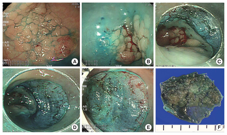 Minimally invasive treatments for early colorectal cancer: comparison of endoscopic resection and laparoscopic surgery.