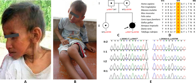 Whole-exome sequencing revealed a novel ERCC6 variant in a Vietnamese patient with Cockayne syndrome.