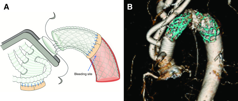 Bailout Solution for Hemostasis from Distal Anastomotic Site during Total Aortic Arch Repair.