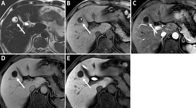 Atypical Hepatic Hemangioma with Fluid-Fluid Level on CT and MRI: Emphasis on Added Value of Contrast-Enhanced Ultrasound Findings.