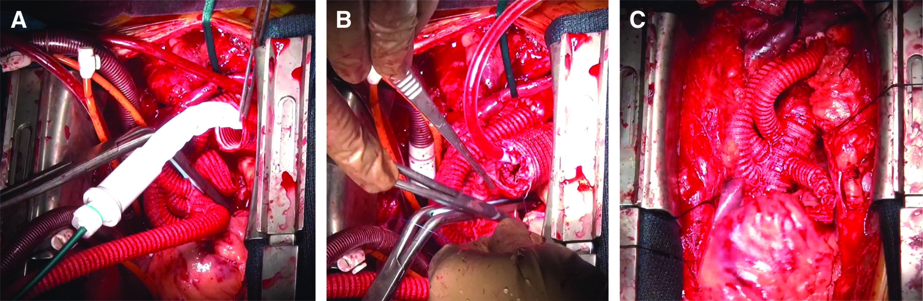 Bailout Solution for Hemostasis from Distal Anastomotic Site during Total Aortic Arch Repair.