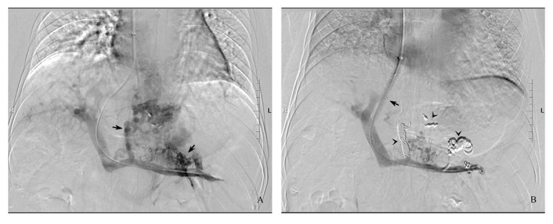 Elective Transjugular Intrahepatic Portosystemic Shunt Using Viatorr Stent-Grafts: A Single-Center Experience from China.