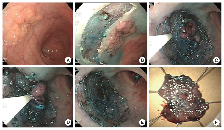 Minimally invasive treatments for early colorectal cancer: comparison of endoscopic resection and laparoscopic surgery.