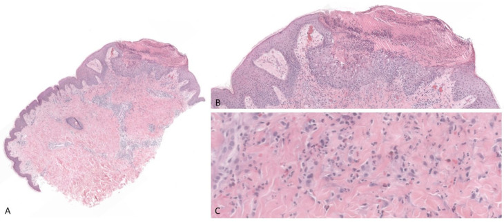 Pseudo-Pemphigoid Gestationis Eruption Following SARS-CoV-2 Vaccination with mRNA Vaccine.
