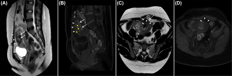 Multimodal postpartum imaging of a severe case of Couvelaire uterus.