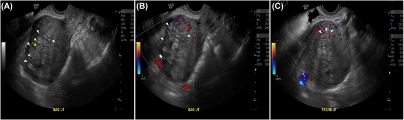 Multimodal postpartum imaging of a severe case of Couvelaire uterus.