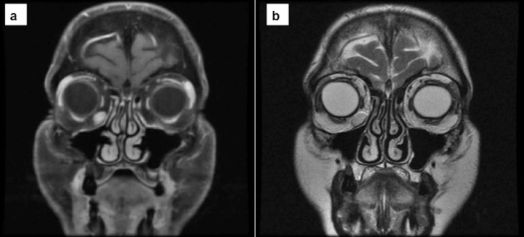 Unusual extraconal orbital location of a cavernous hemangioma.