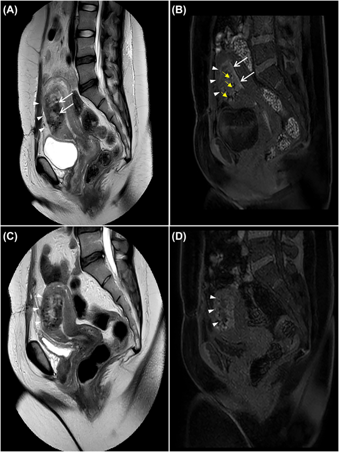 Multimodal postpartum imaging of a severe case of Couvelaire uterus.