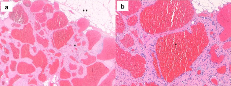 Unusual extraconal orbital location of a cavernous hemangioma.