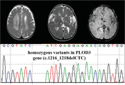 Cerebral small vessel disease caused by <i>PLOD3</i> mutation: Expanding the phenotypic spectrum of lysyl hydroxylase-3 deficiency.