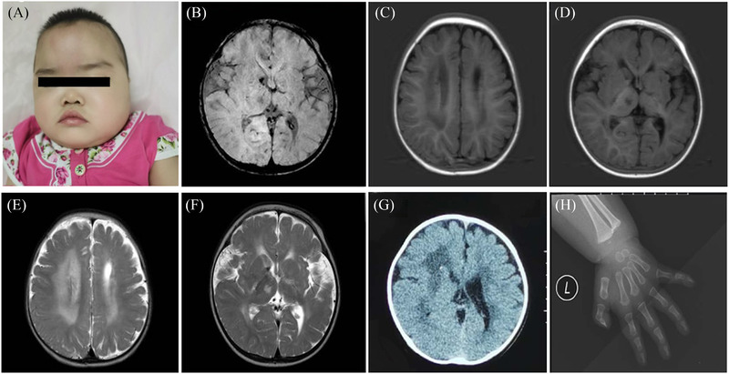 Cerebral small vessel disease caused by <i>PLOD3</i> mutation: Expanding the phenotypic spectrum of lysyl hydroxylase-3 deficiency.