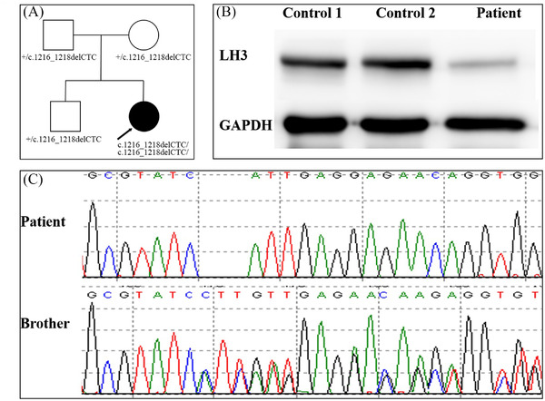 Cerebral small vessel disease caused by <i>PLOD3</i> mutation: Expanding the phenotypic spectrum of lysyl hydroxylase-3 deficiency.