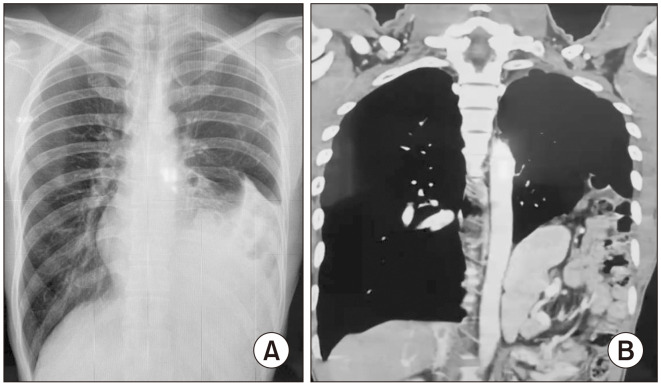 Laparoscopic approach in chronic posttraumatic diaphragmatic hernia.